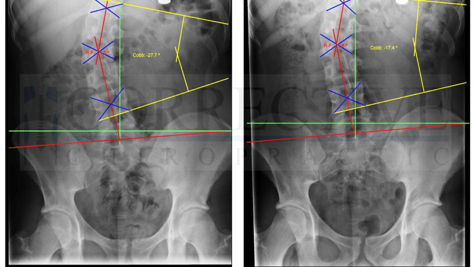 Corrective Chiropractic X-Ray Results