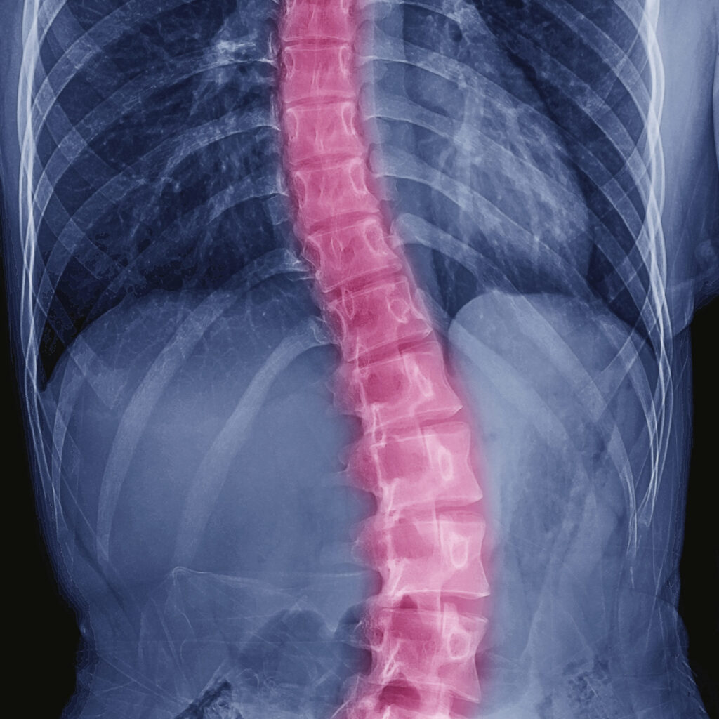 Scoliosis X-Ray Greenville NC